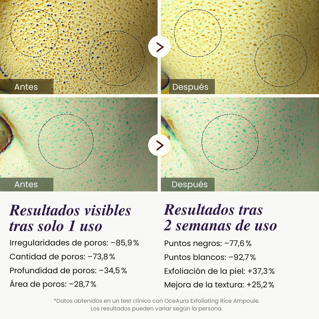 Reductor de puntos negros - Piel sin manchas