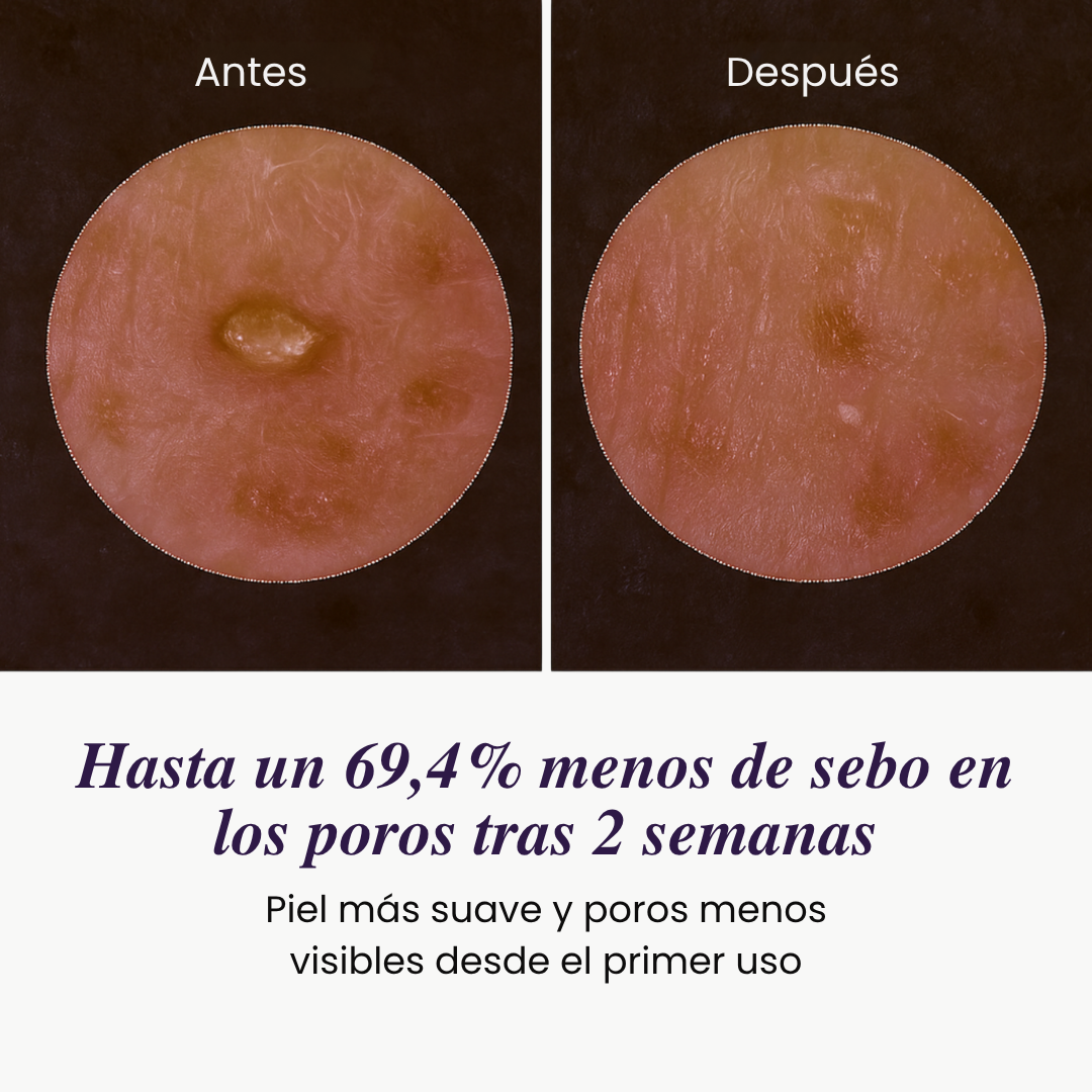 Reductor de puntos negros - Piel sin manchas